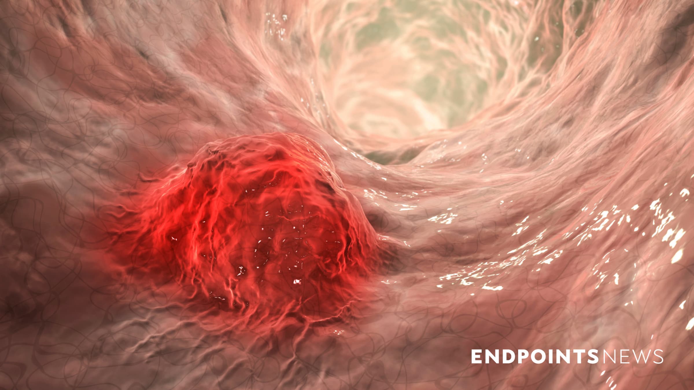 Exelixis' positive Phase 3 colorectal cancer data boost stock