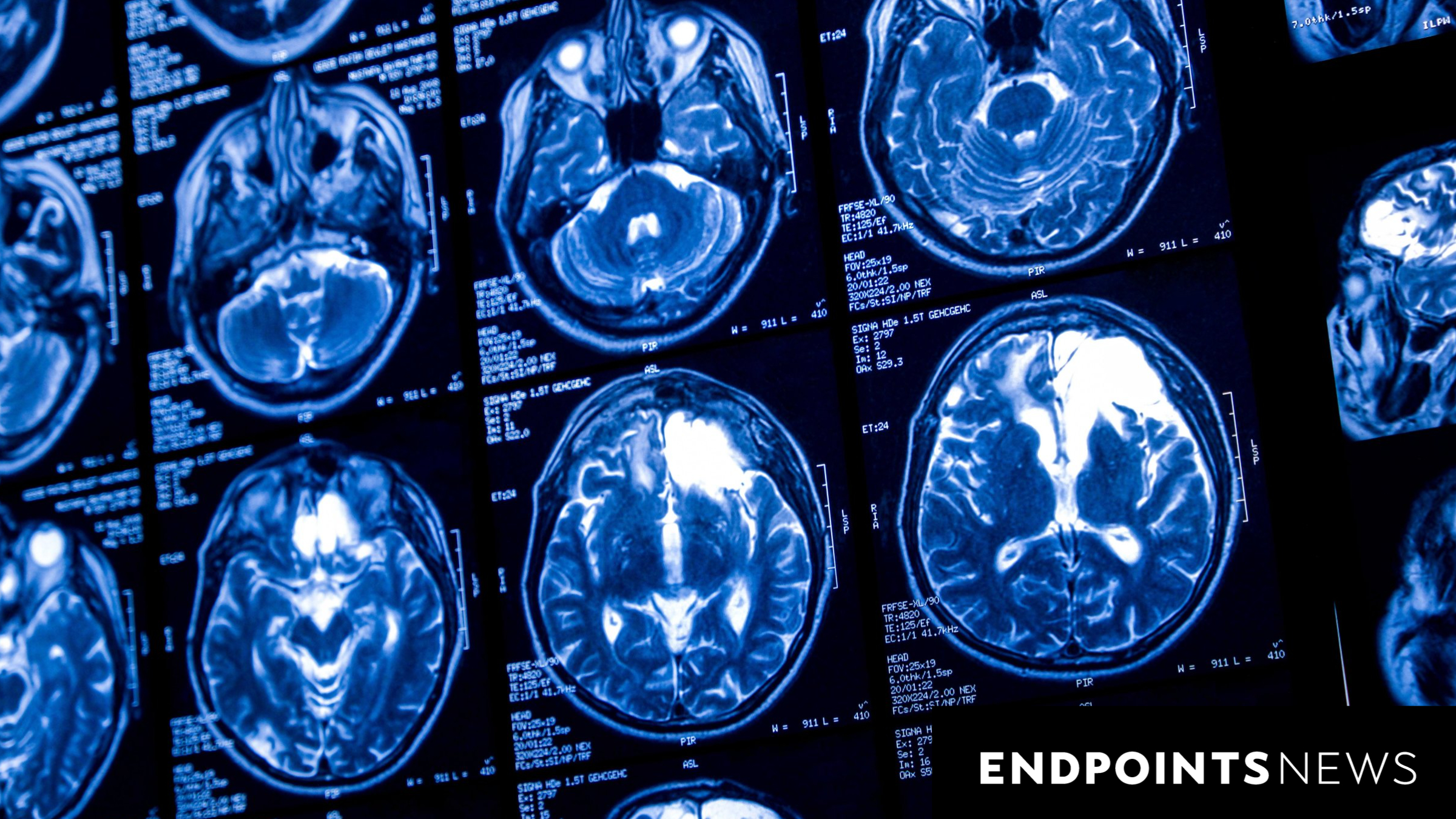 #ASCO25: Brain cancer cell therapies make early strides
